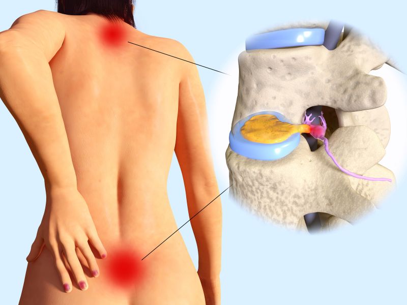 qué es la hernia lumbar y cervical