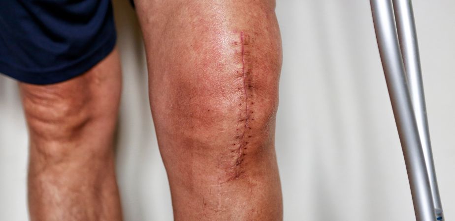 tratar cicatrices en fisioterapia en la zona rodilla