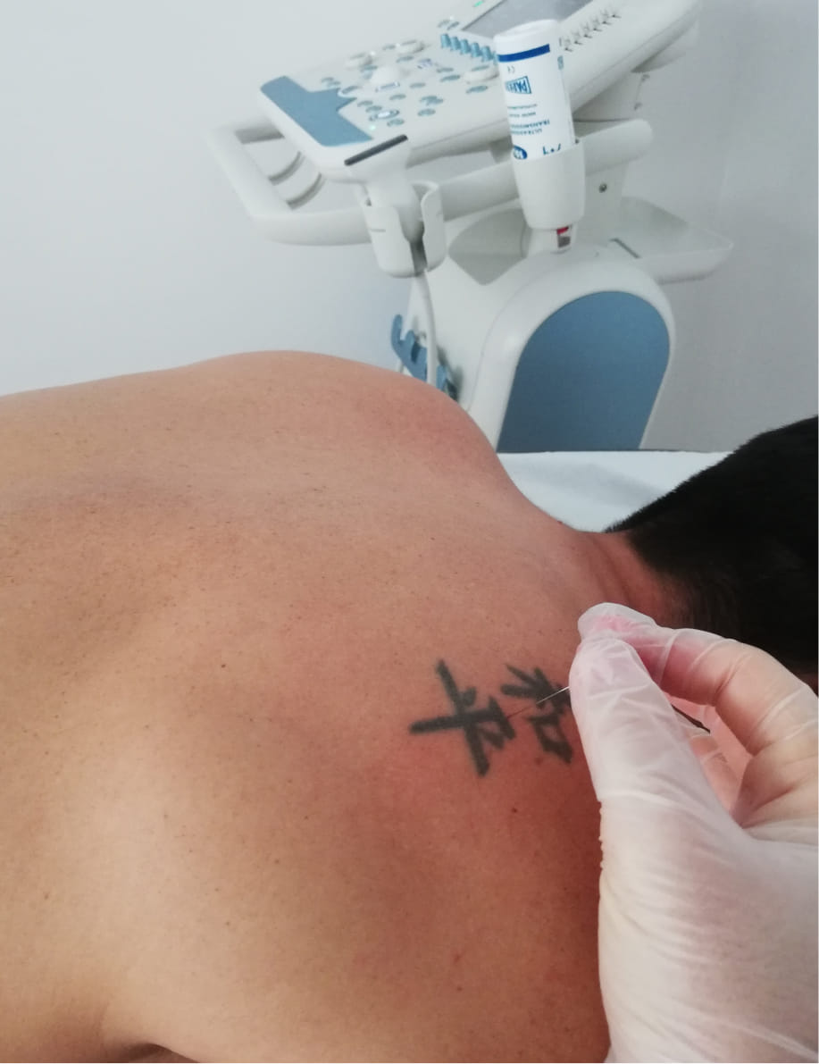 acupuntura puncion acupuntura y punción seca