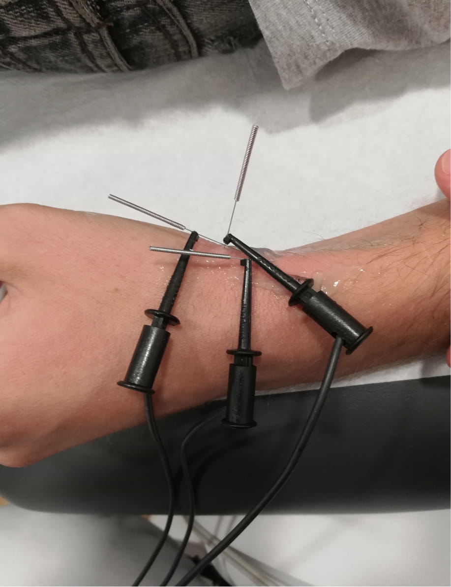 electrolisis percutanea electrólisis percutánea intramuscular